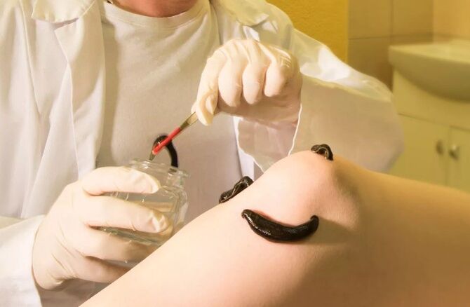 Hirudoterapia para venas varicosas