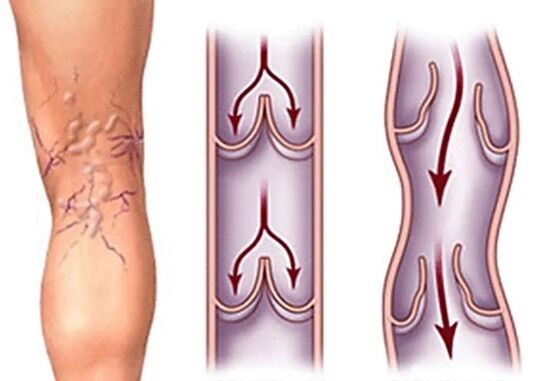 Vena normal y varicosa