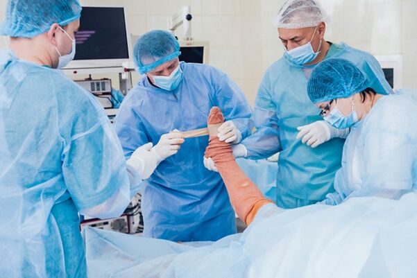 Operación de varicosis