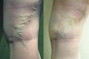 Venas varicosas en las piernas