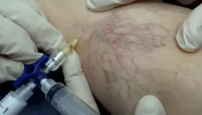 escleroterapia para venas varicosas