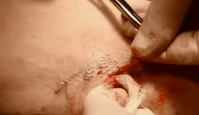 tipos de operaciones para eliminar las venas varicosas