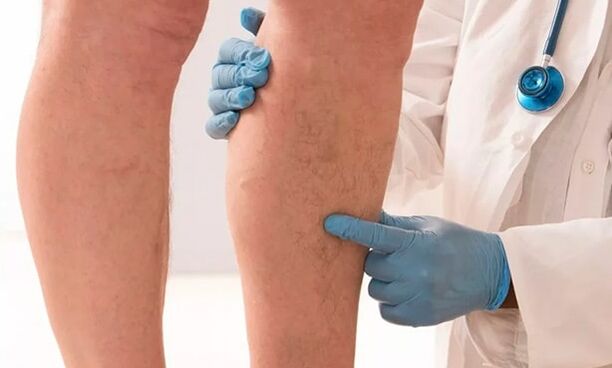 El médico examina las piernas en busca de venas varicosas.